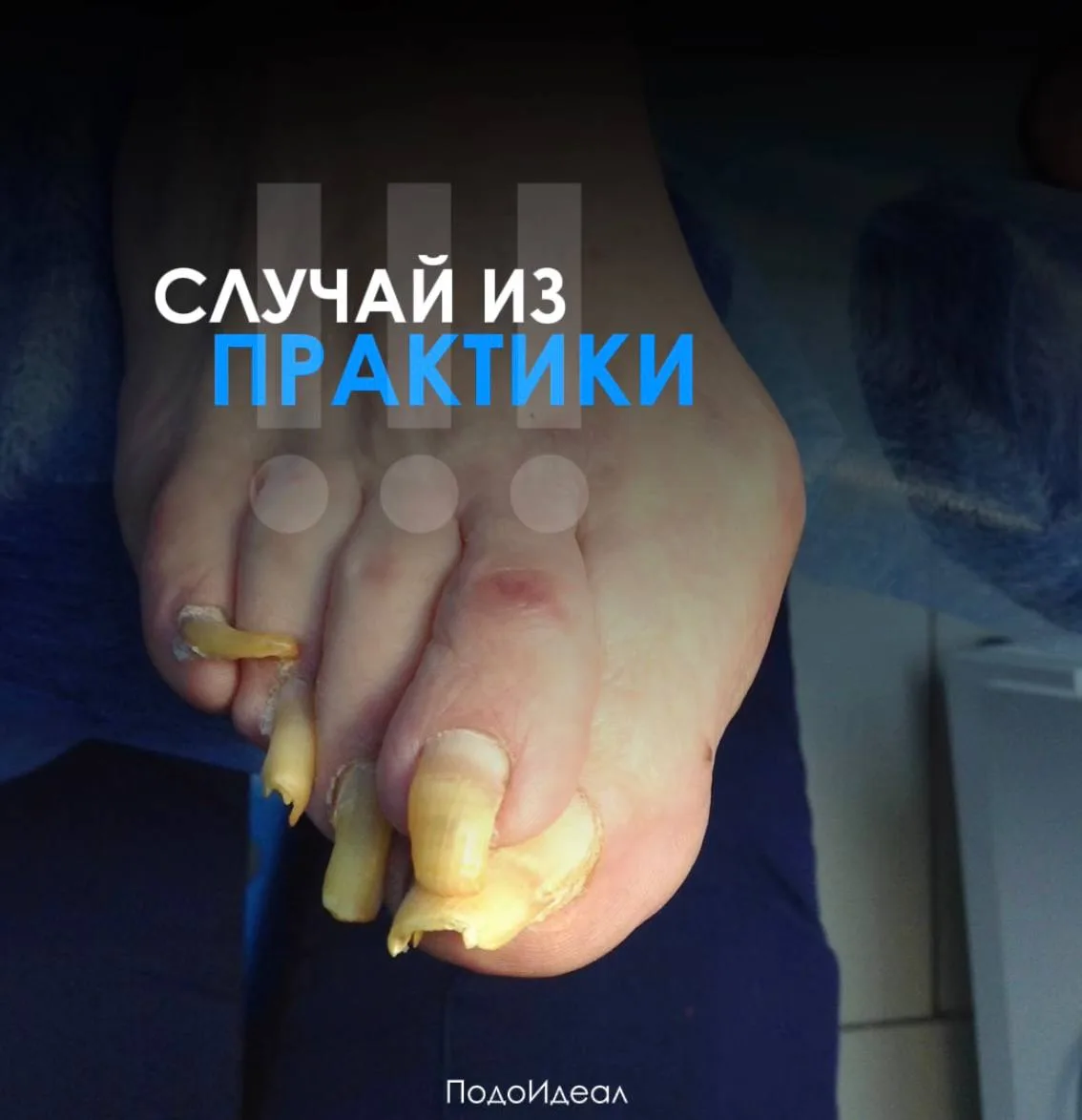 Случай из практики подологический педикюр!

✅Записаться:✅

✅В личных сообщениях группы
✅По телефону: