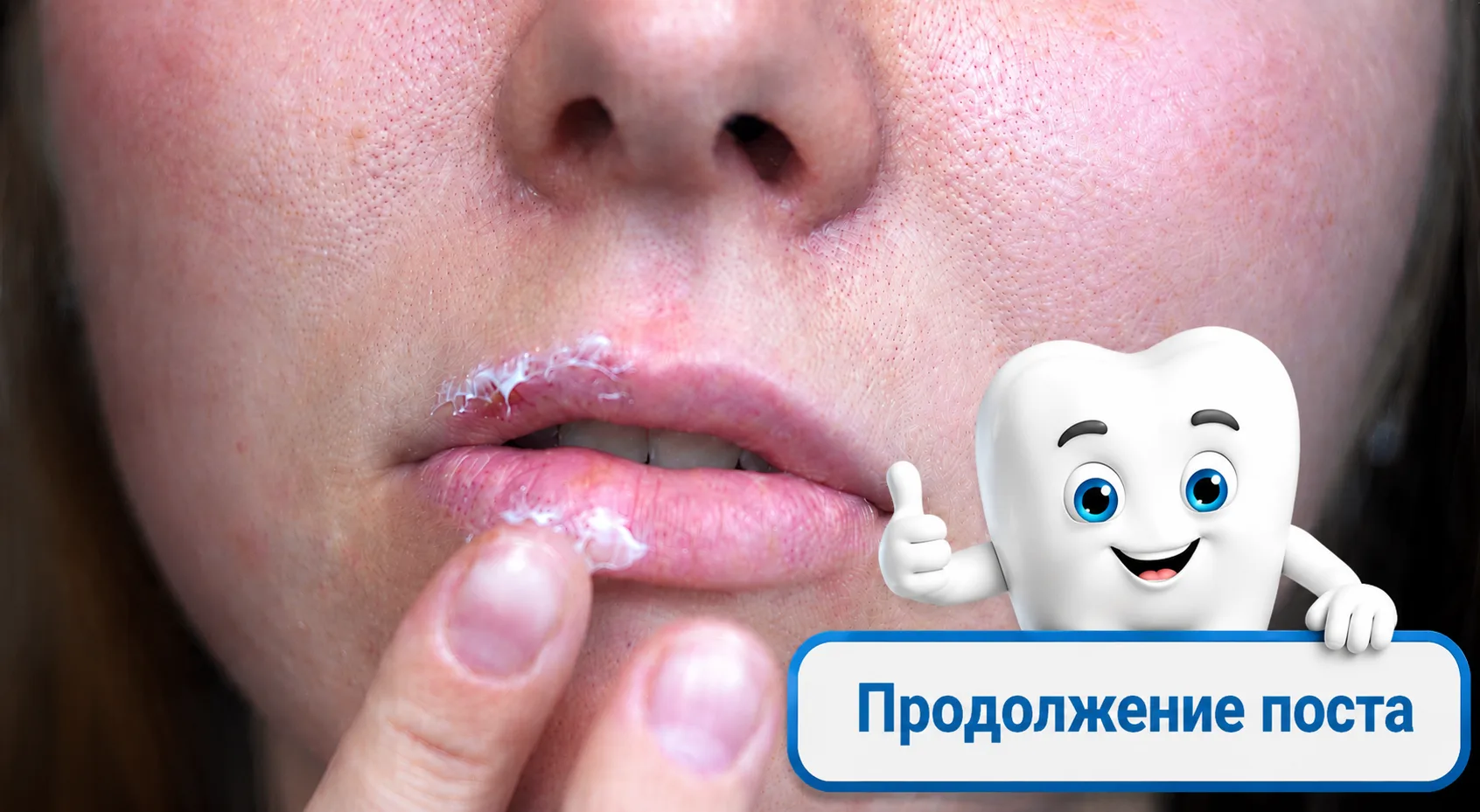 ч.2 Можно ли чистить зубы при обострении дерматита вокруг рта? Тактика выживания

В прошлой публикац