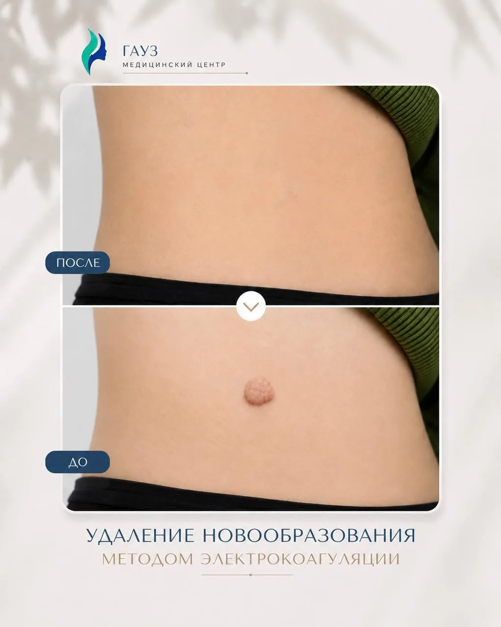 Кейс: удаление новообразования методом электрокоагуляции

В ГАУЗ «Медицинский центр» пациент обратил