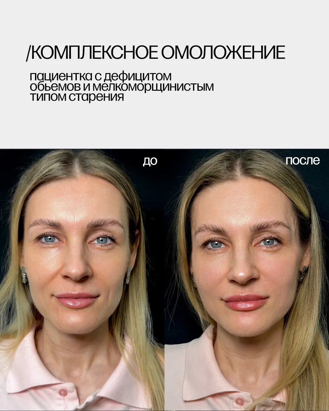 Молодое лицо — всегда наполненное, с щечками, подтянутое и с пухлыми губами 🌸