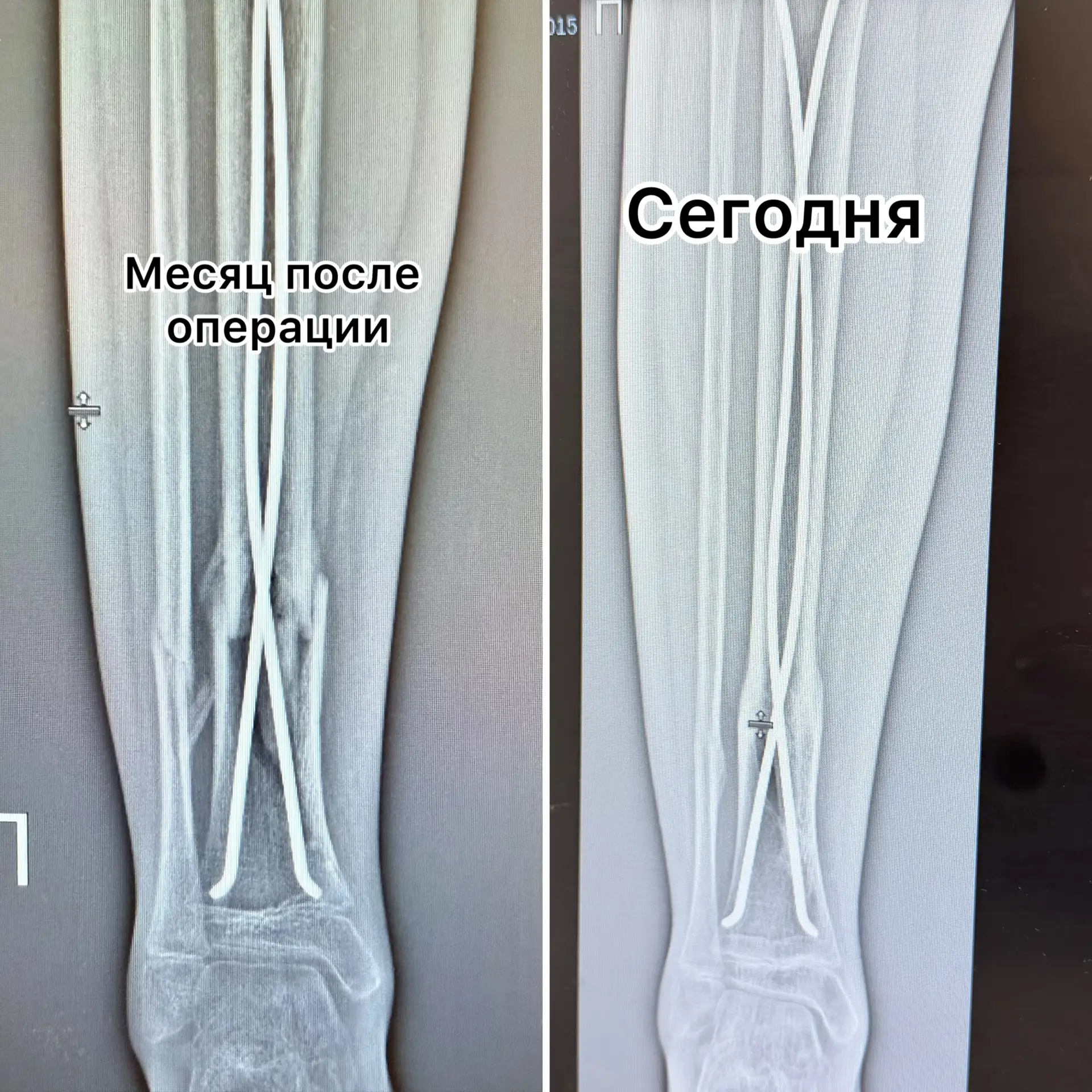 Сегодня с Арсением ездили на снимок ноги.☺️
Напомню, что 2 сентября он серьезно сломал ногу, на фото