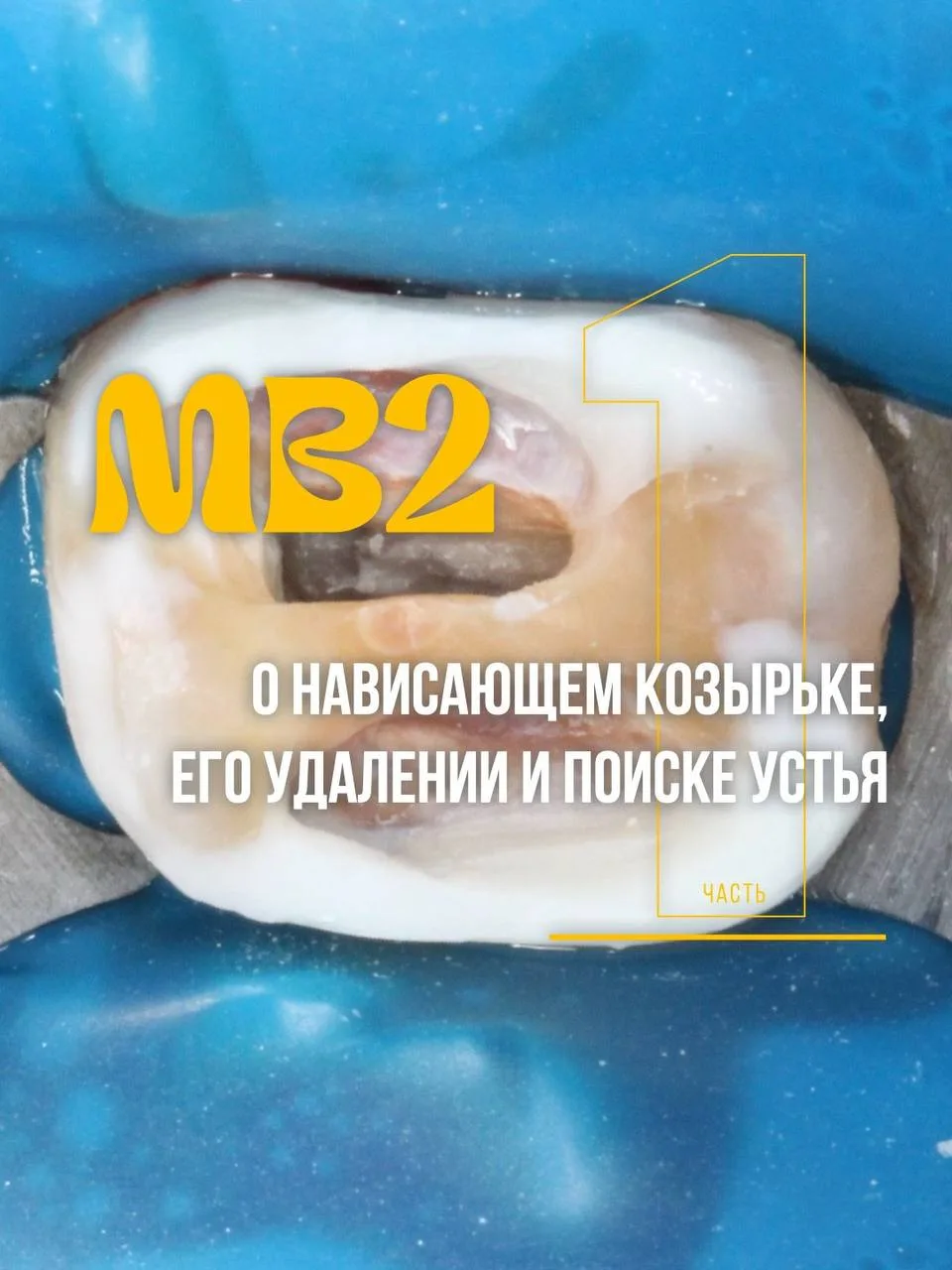 ✨️Первая сложность, с которой мы можем столкнуться при поиске mb2-канала, это нависающий козырек ден
