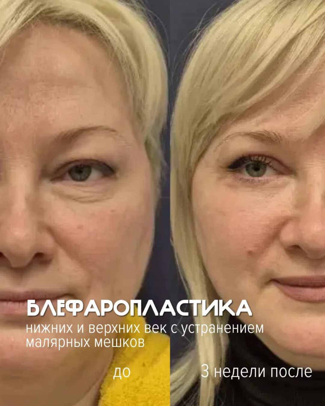 «Уберите эти мешки!» - именно такую формулировку слышат наши пластические хирурги. 

Хорошая новость
