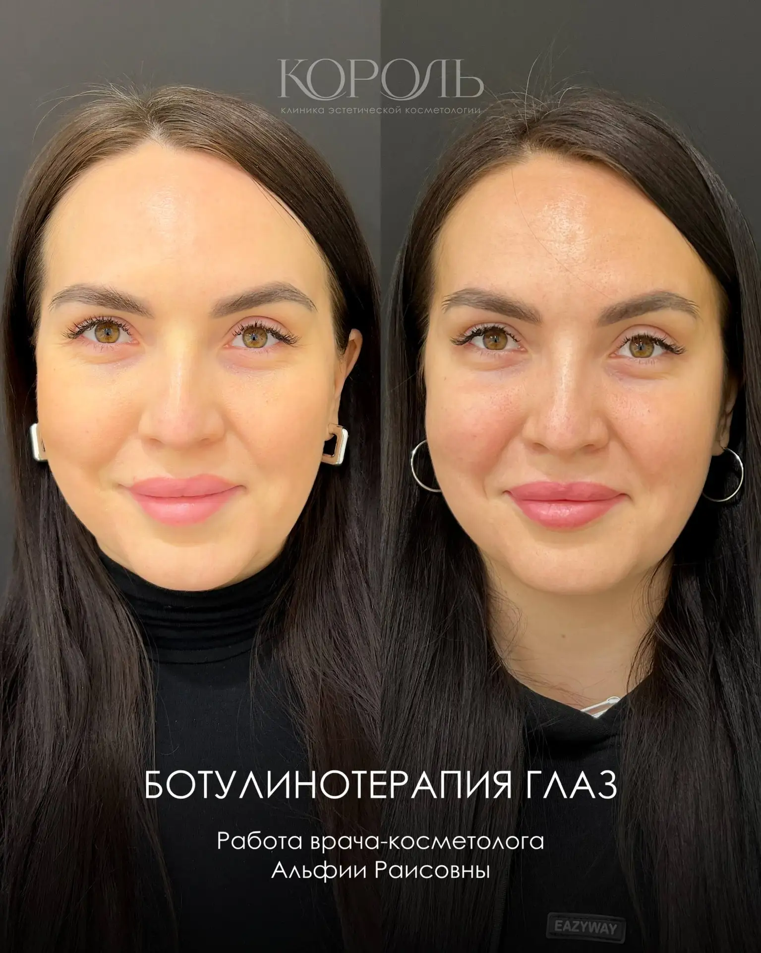 Делимся с вами новой работой нашего врача-косметолога – Альфии Раисовны ✨

На фото пациенту выполнен