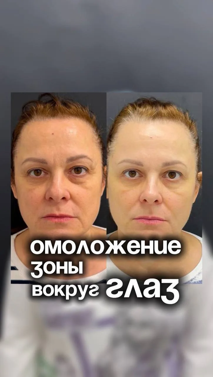 Взгляд как после отпуска 🏝️

Провели процедуру Биоматрикс на зону вокруг глаз и получили яркий, но 