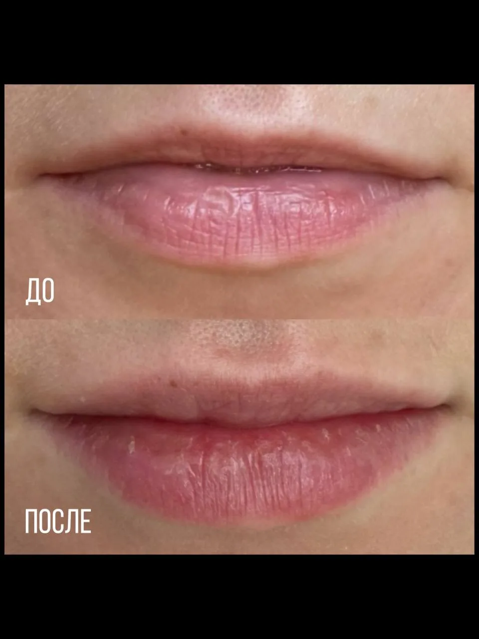 Результат контурной пластики губ препаратом Belotero в VIP CLINIC🤍

Задача:
 — скорректировать форм