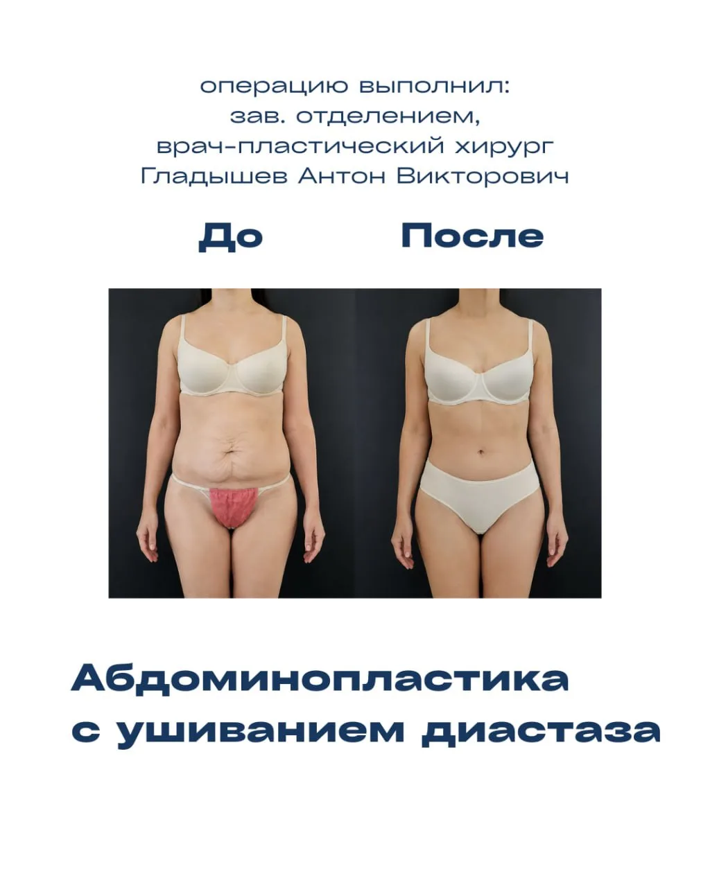 Год после абдоминопластики ✨

Пациентку беспокоили диастаз прямых мышц живота и избыток кожи, из-за 