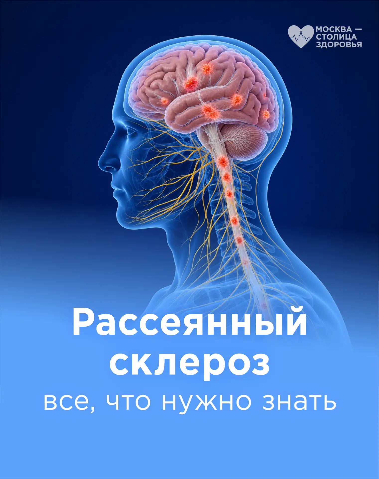 💬 Рассеянный склероз: все, что нужно знать о заболевании

В обществе термин «склероз» часто ошибочн