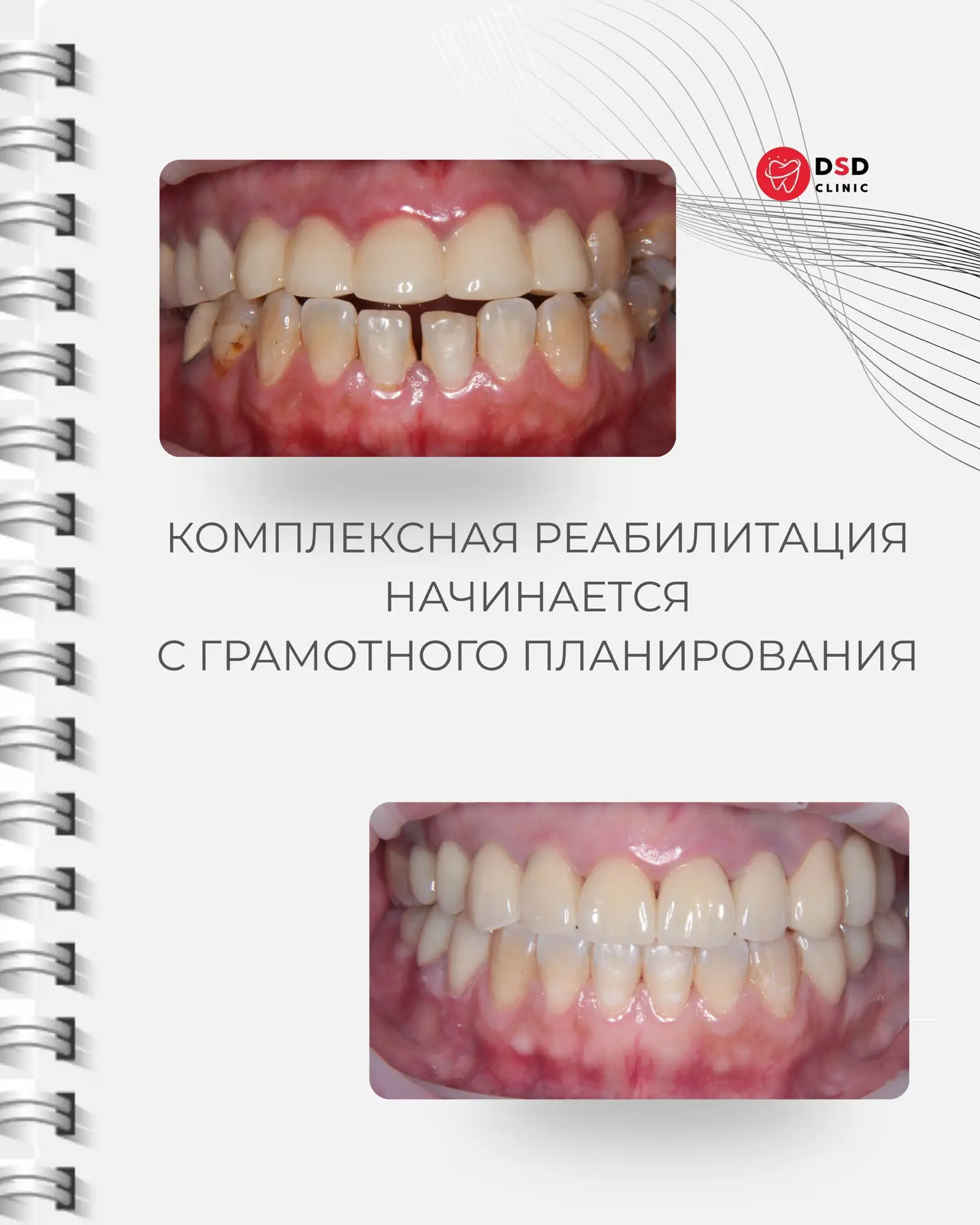 🦷Комплексная стоматология — это всегда больше, чем просто лечение одного зуба.

В этом кейсе мы про
