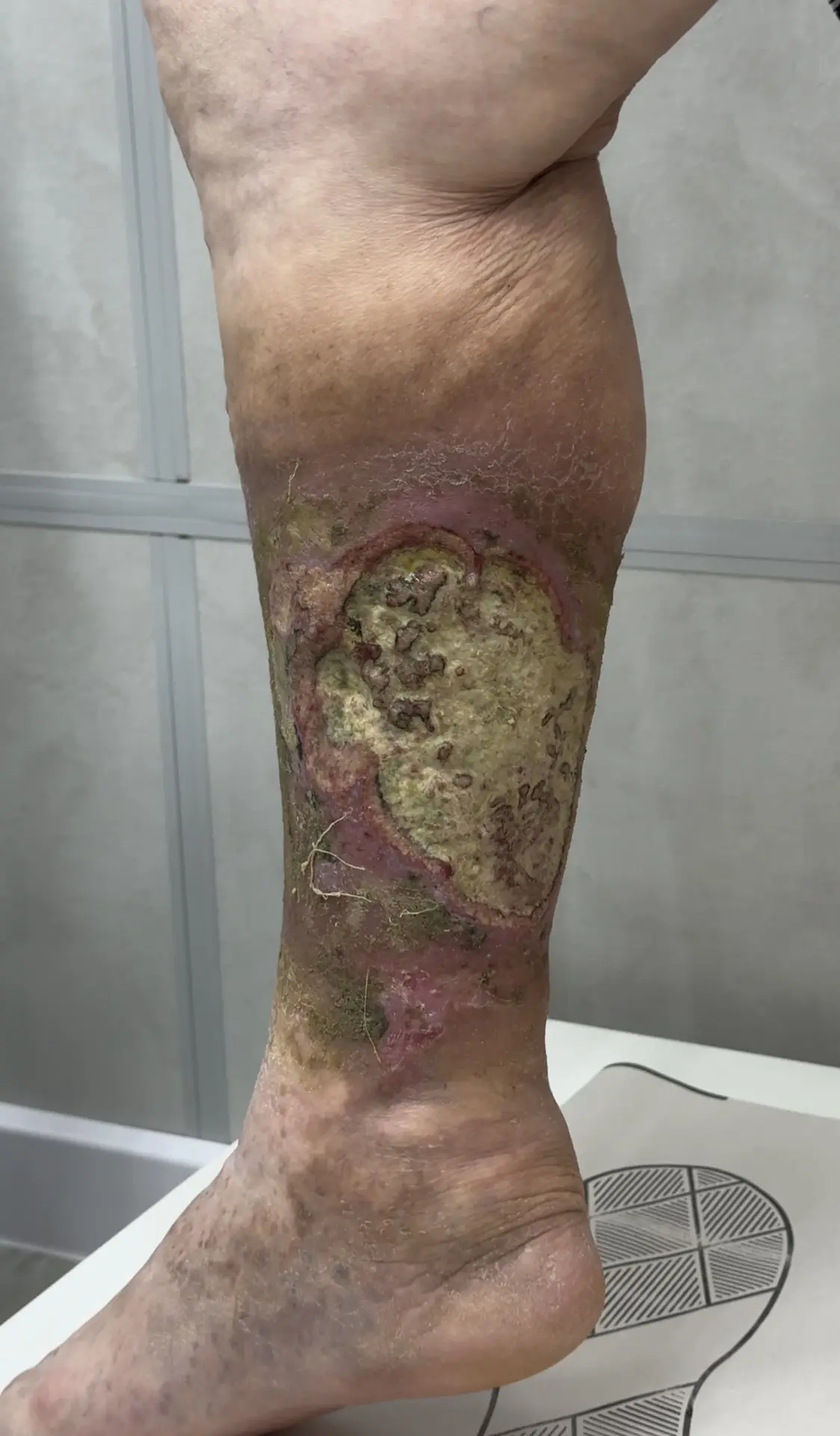 Дорогие друзья, хочу показывать вам фотографии трофической язвы, с которой моя пациентка живёт уже 7