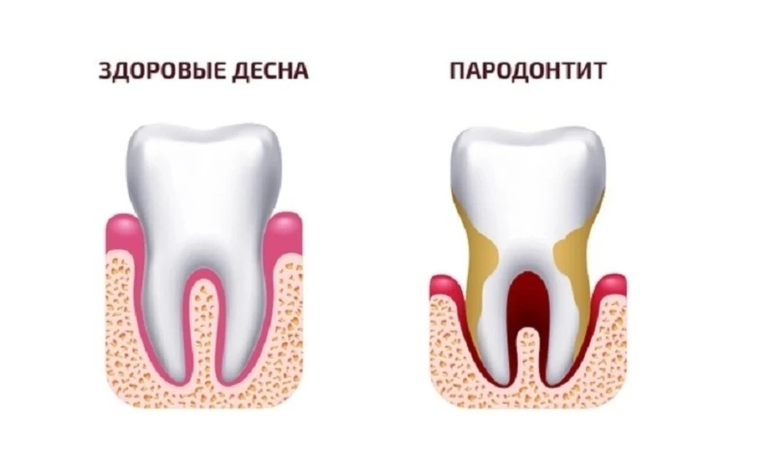 Пародонтит — это острое или хроническое стоматологическое заболевание, которое сопровождается воспал