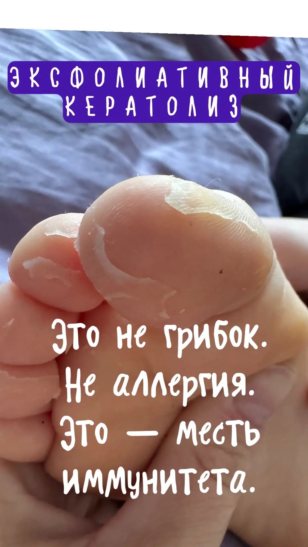 «После ротавируса у ребёнка слезают стопы. Это нормально?» — объясняю как педиатр

👩‍⚕️ Реальная ис