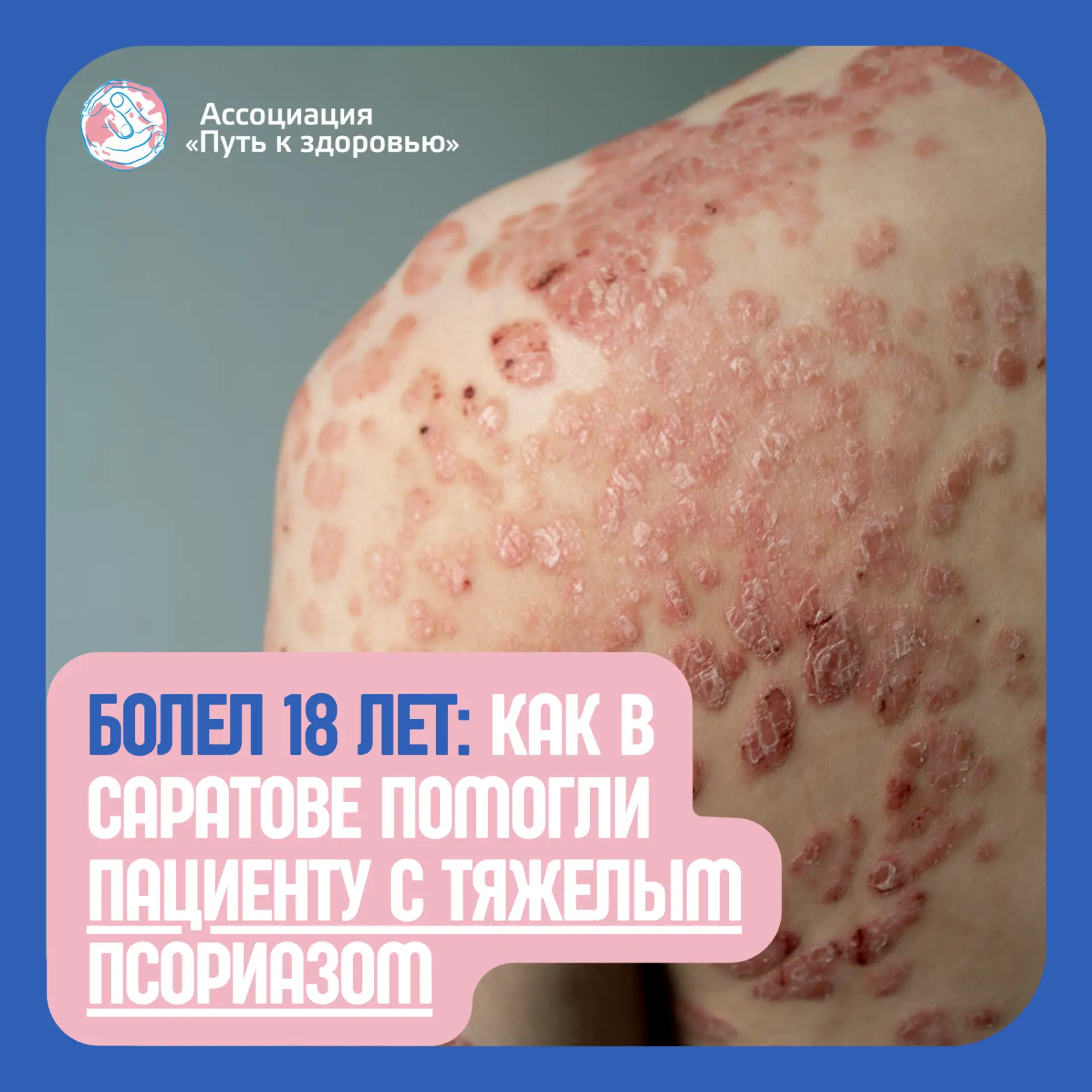 Как ГИБТ победил тяжёлый псориаз: случай в регионе
Свежий пример того, какой эффект может дать генно