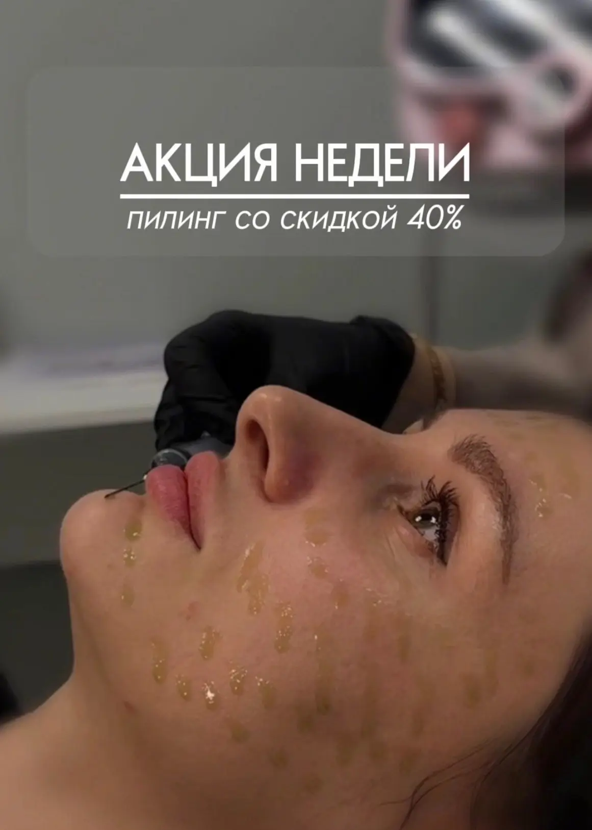 АКЦИЯ НЕДЕЛИ - ПИЛИНГ 40%
Востребованная процедура всего за 2400 ₽ (вместо 3900 ₽)

Условия акции:
•