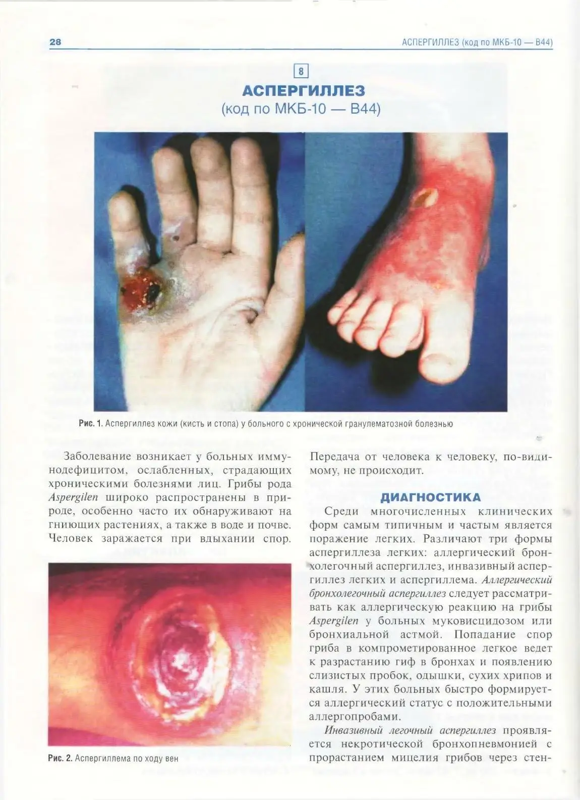 Аспергиллез