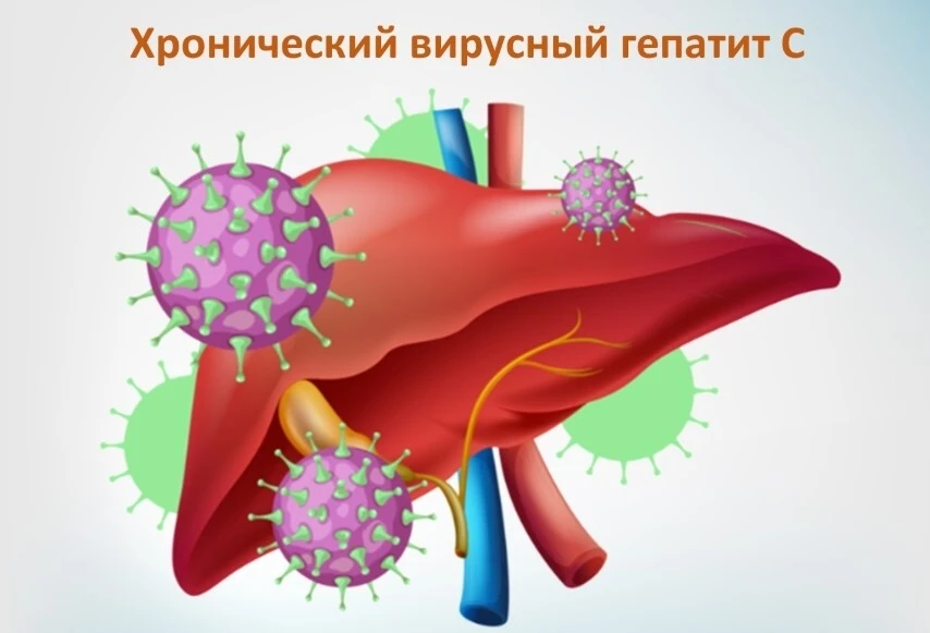 🩺 Вирусный гепатит С: что важно знать

Гепатит С — это инфекционное заболевание с преимущественным 