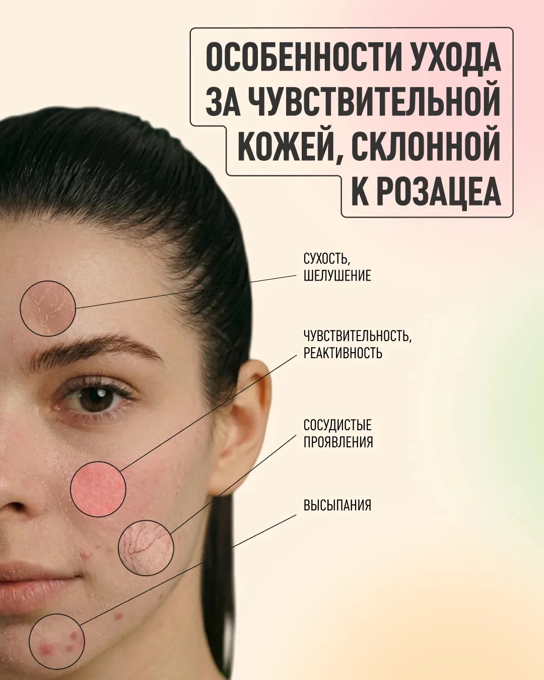«Особенности ухода за чувствительной кожей, склонной к розацеа»

Чувствительная кожа – это один из о
