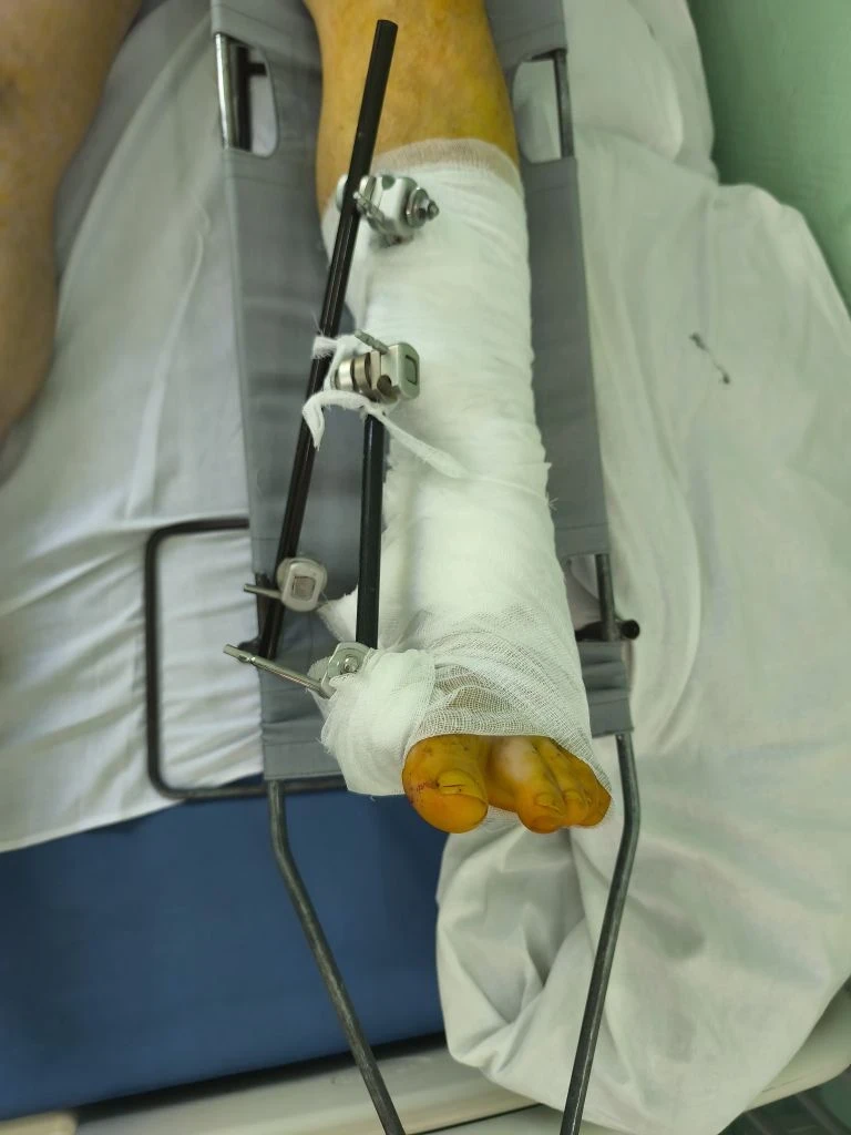 🏥 В Городской больнице №38 им.Н.А.Семашко проведена сложная экстренная операция, позволившая сохран