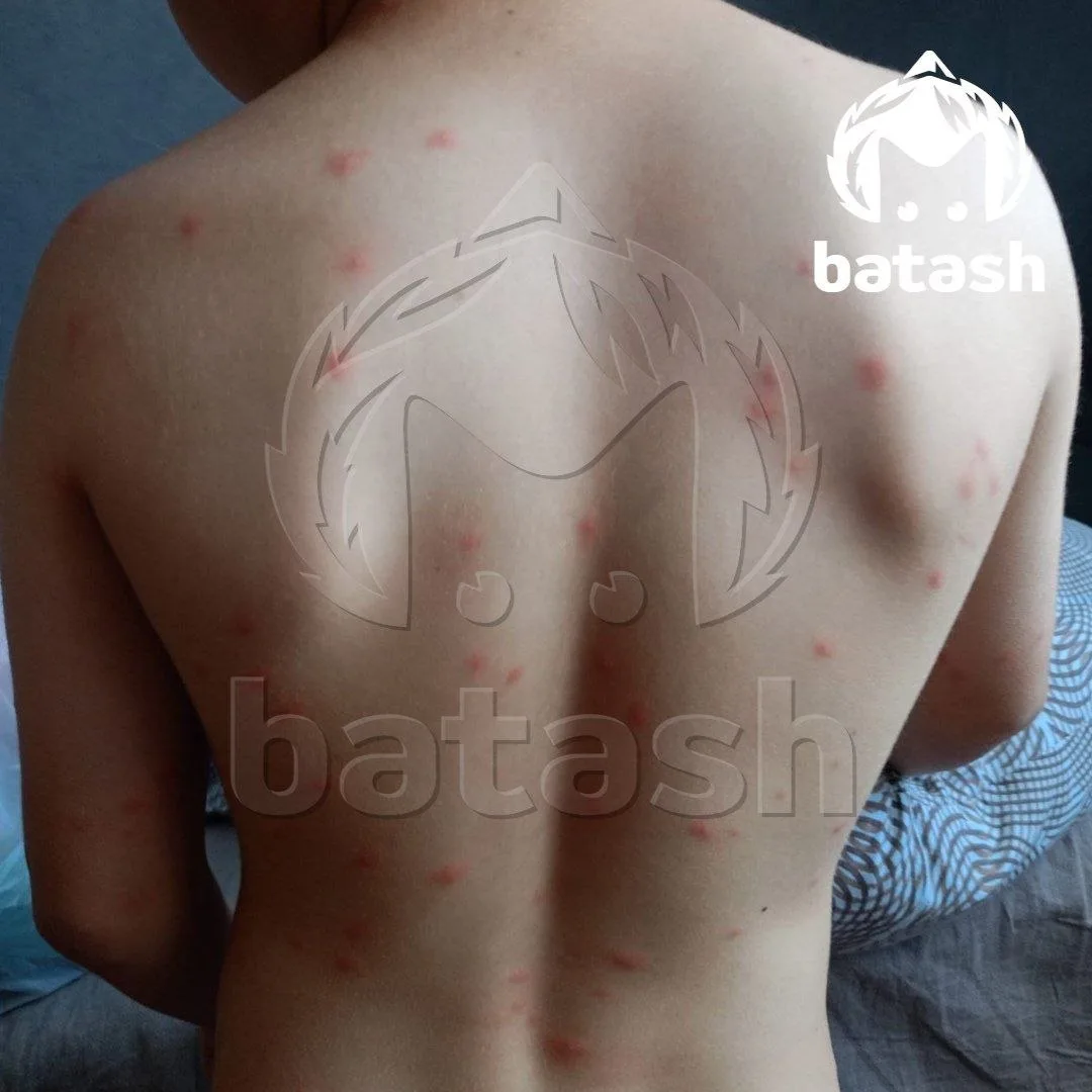 Зудящие волдыри вылезли на телах уфимцев после купания в Кашкадане.

Одна из посетительниц пляжа в С