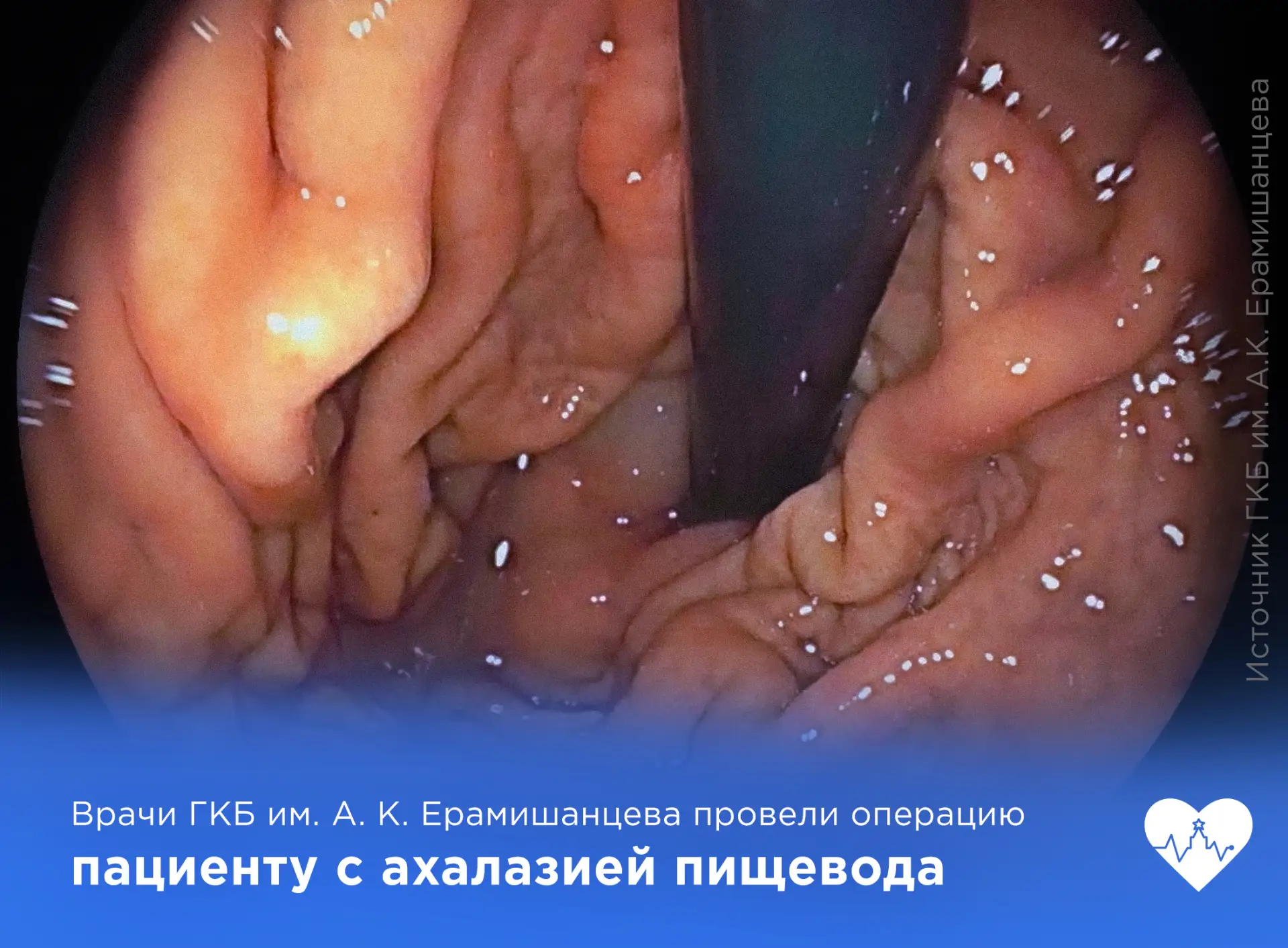 Врачи ГКБ им. А.К. Ерамишанцева провели операцию на пищеводе без внешних разрезов. 

В ГКБ им. А. К.
