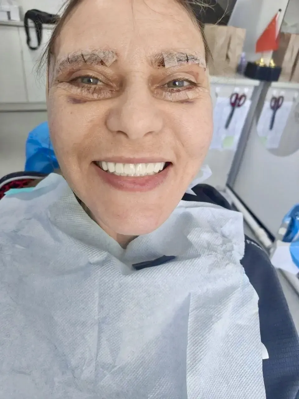 Светлана, 
город Калининград 

🦷План протезирования:
Верх - 4 моста, 13 единиц  
Низ - 4 моста, 14 
