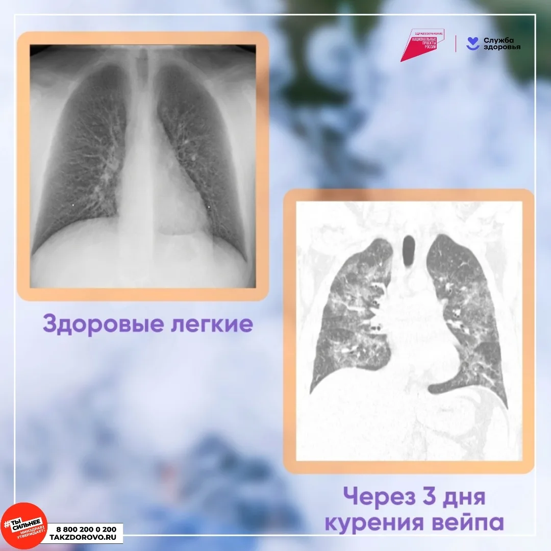 ❗ДЕТИ, ОСТОРОЖНО❗
 
💡ДИАГНОЗ - EVALI (ИЛИ БОЛЕЗНЬ ВЕЙПЕРОВ). 
 Использование электронных сигарет и 