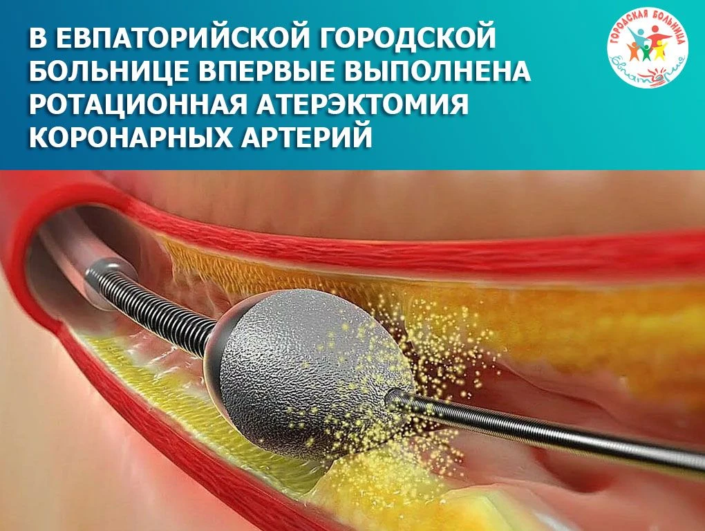 В ЕВПАТОРИЙСКОЙ ГОРОДСКОЙ БОЛЬНИЦЕ ВПЕРВЫЕ ВЫПОЛНЕНА РОТАЦИОННАЯ АТЕРЭКТОМИЯ КОРОНАРНЫХ АРТЕРИЙ
15 м