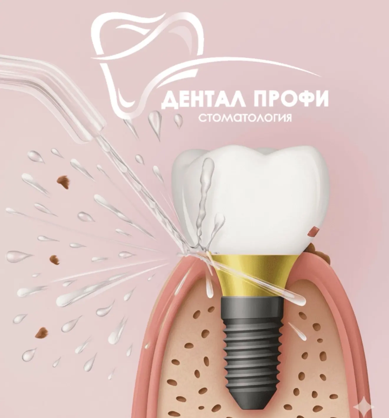 🦷 ИМПЛАНТЫ СТОЯТ ИДЕАЛЬНО? Тогда самое время поговорить о том, что скрыто от глаз 👀

Многие пациен