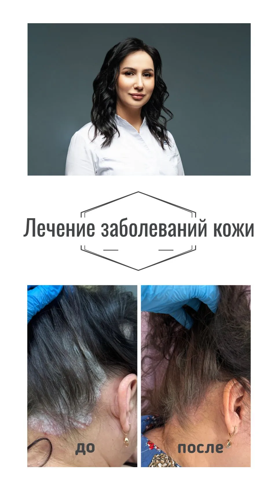 🔺️Правда о лечении псориаза: взгляд из центра «Сибирка»

🔹️Псориаз — это не просто высыпания на ко