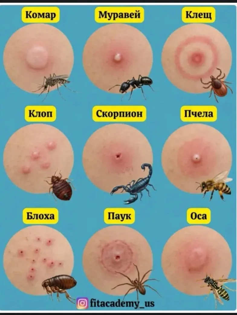 А вы знали, как выглядят укусы некоторых насекомых? Возможно, пригодится