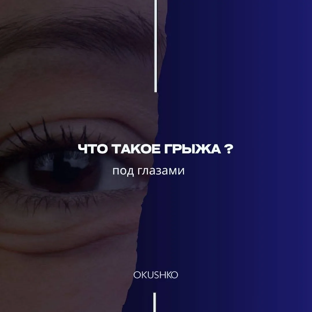 Грыжа под глазом возникает, когда жировая ткань из‑под нижнего века (которая в норме служит «подушко
