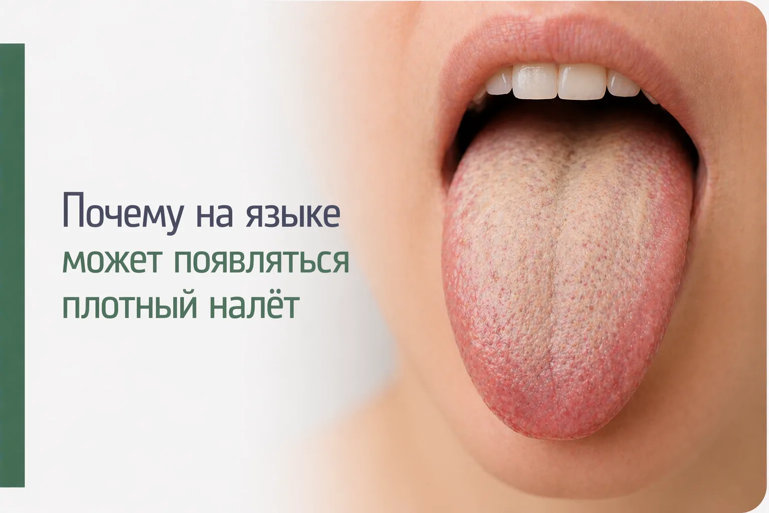 🦷 Почему на языке может появляться плотный налёт

Иногда человек замечает, что язык стал более белы