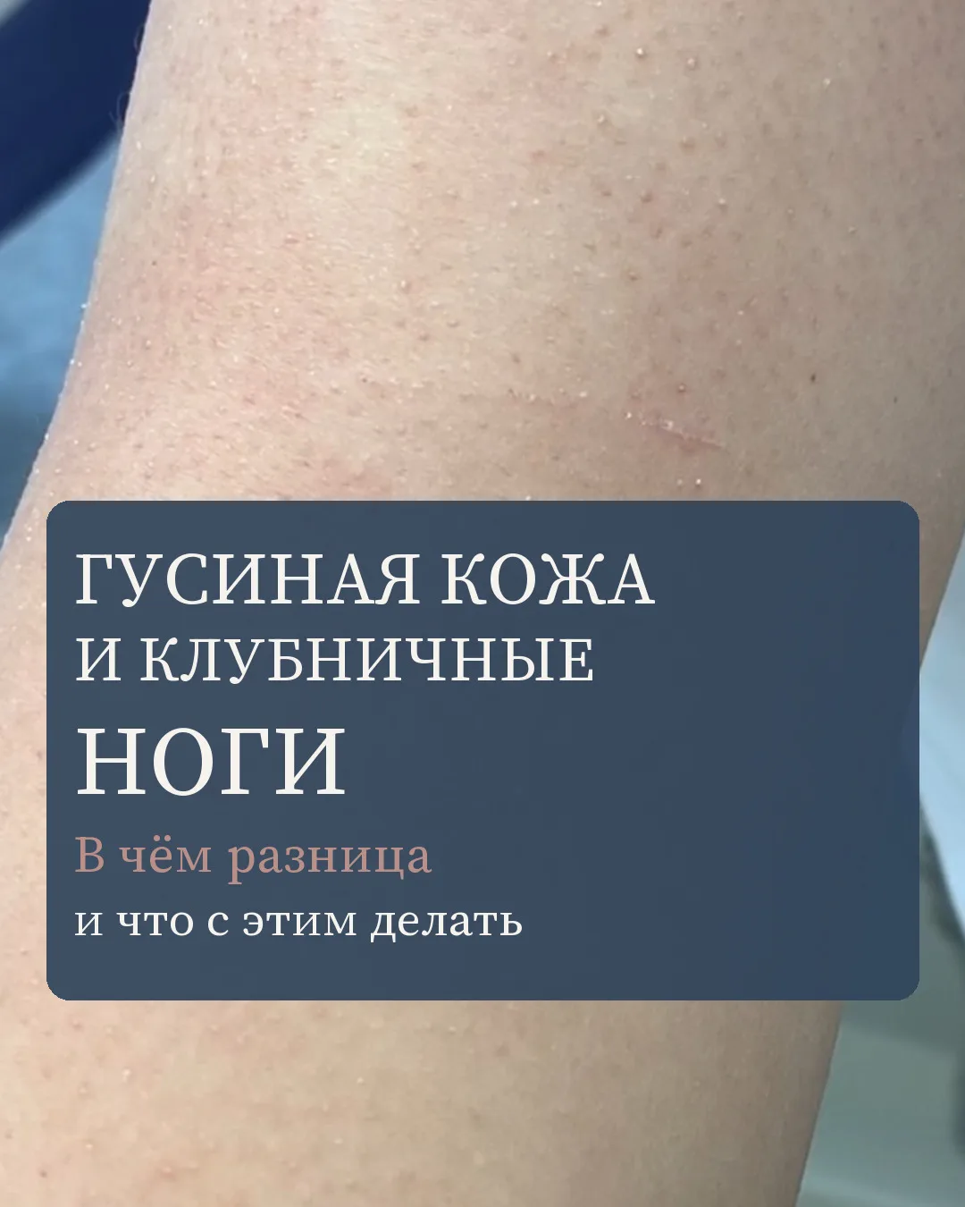 Мурашки на плечах или тёмные точки на ногах после депиляции — знакомо? Это два похожих, но разных яв