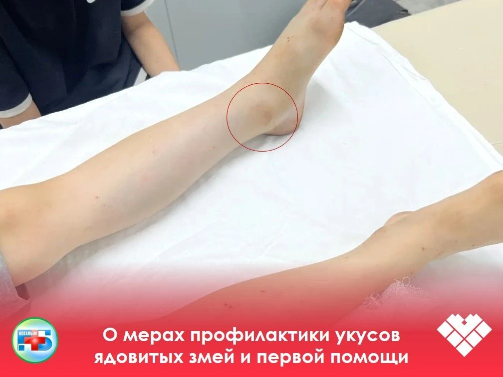 В Когалымской городской больнице был экстренно принят 9-летний мальчик с укусом змеи. Змея спряталас