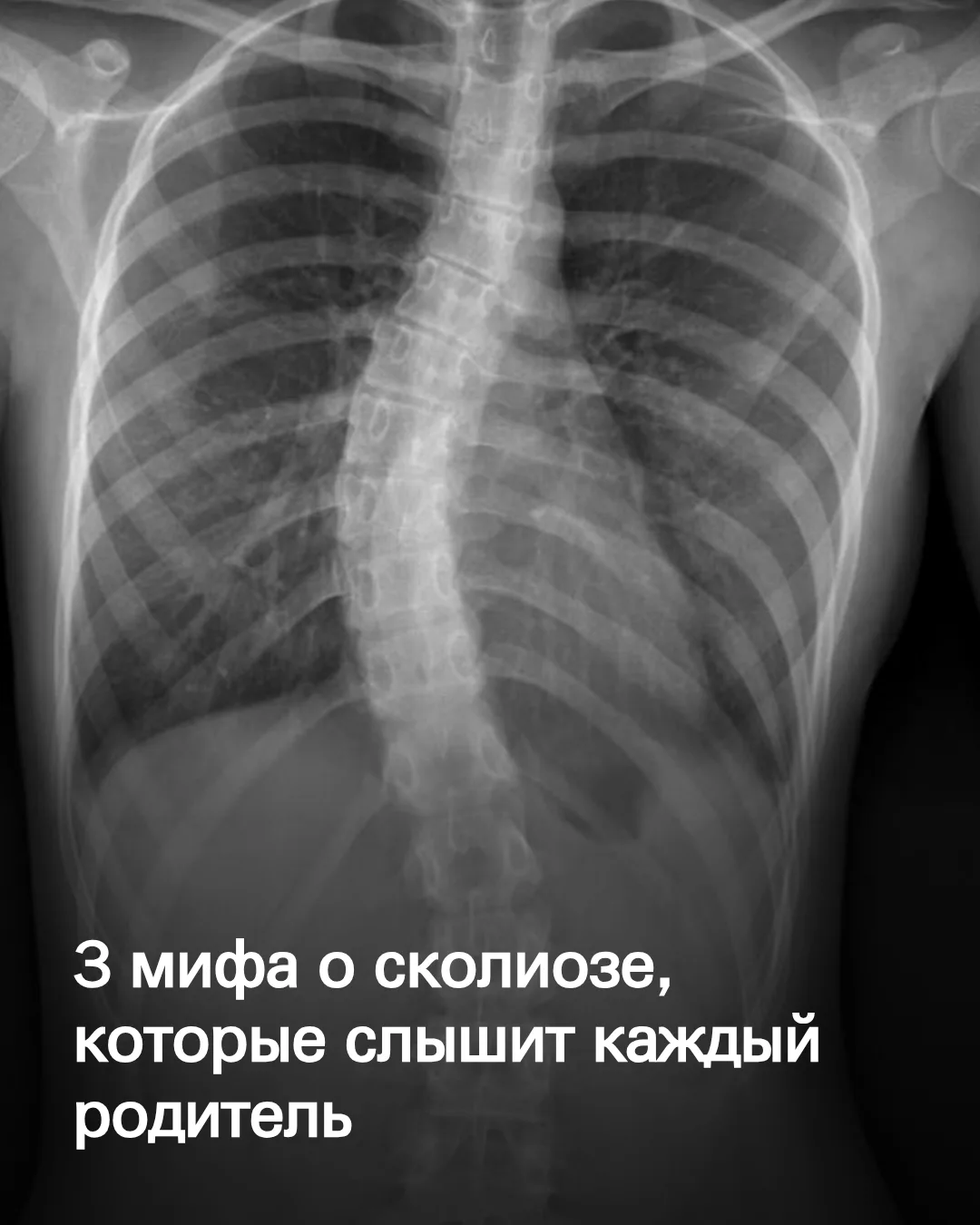 В карусели поделился самыми частыми мифами о сколиозе, которые слышал каждый родитель на приеме у ор