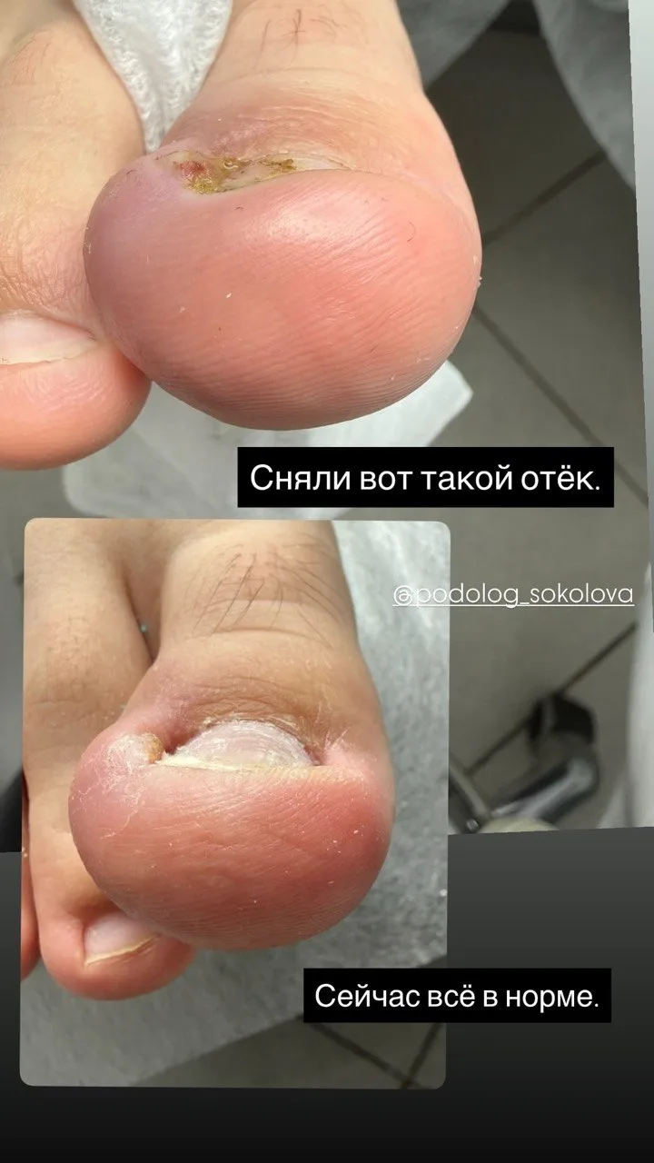 📸 До/После: как холодная плазма убрала отёк и помогла ногтю расти правильно.

Продолжаю показывать 