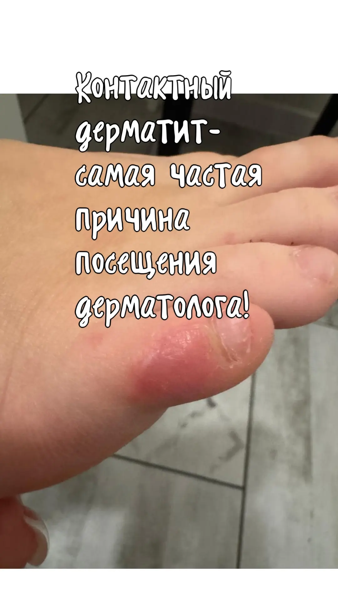 Чувствуете зуд, жжение или шелушение там, где кода трётся об одежду или обувь? 😥

Возможно, это кон