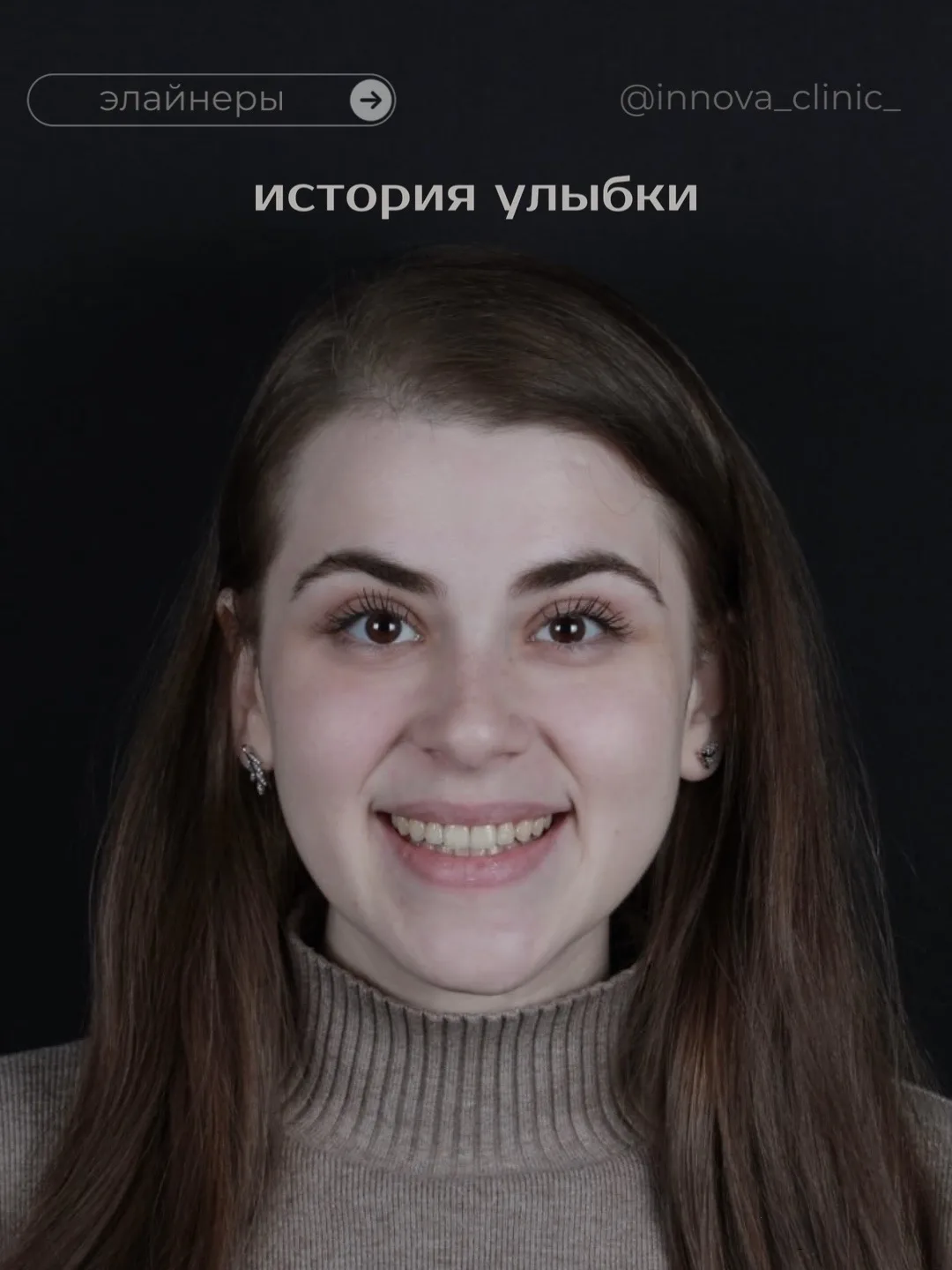 Еще один завершенный кейс на элайнерах ✨

Лечение длилось около 2 лет. Особенность этого случая в то