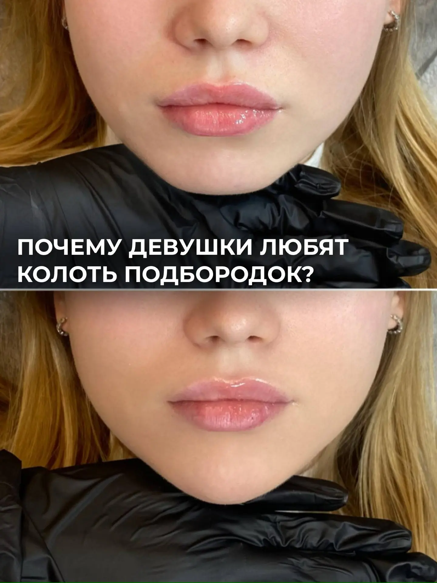 ПОЧЕМУ ВСЕ НАЧАЛИ КОРРЕКТИРОВАТЬ ПОДБОРОДОК? 😱

❗️Потому что это ключевая точка нижней трети лица

