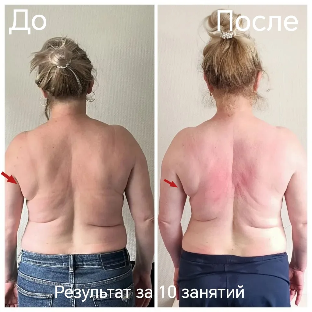 Представляем Вашему вниманию результат женщины за 10 занятий 🔥

✅ Холка на шее уменьшилась,
✅ Право