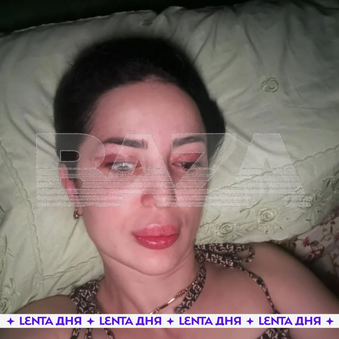 😱 Женщина не может закрывать глаз после неудачной пластики.

Жительница Махачкалы Валадият решилась