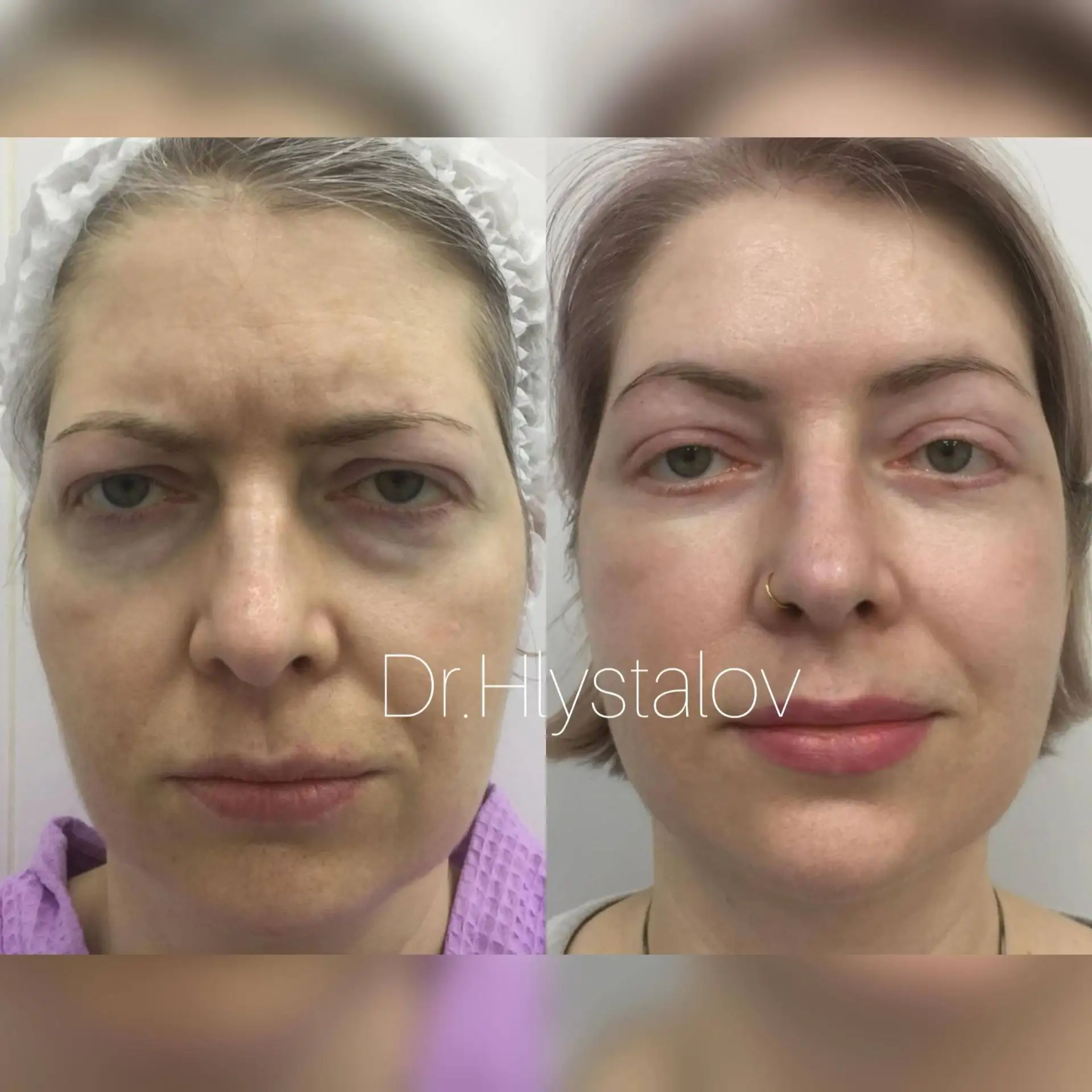 🌀 На фото наша прекрасная пациентка, которой было выполнено периорбитальное омоложение.

✅В ходе оп