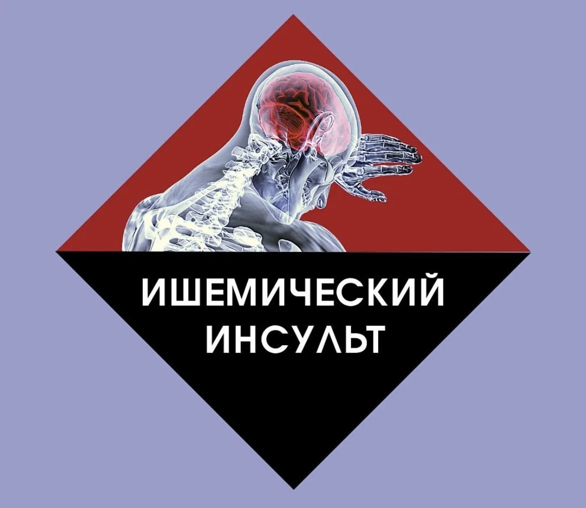 Инсульт🧠- это резкое нарушение
нормального кровоснабжения мозга.
🔹Бывает два вида инсульта: ишемич