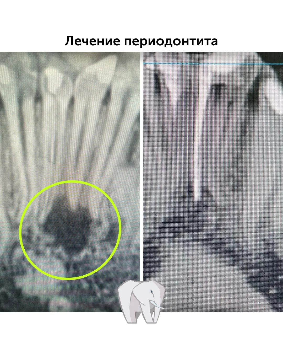 Кисты и гранулемы на верхушках корня лечатся. Заболевание называется периодонтит. Может протекать бе