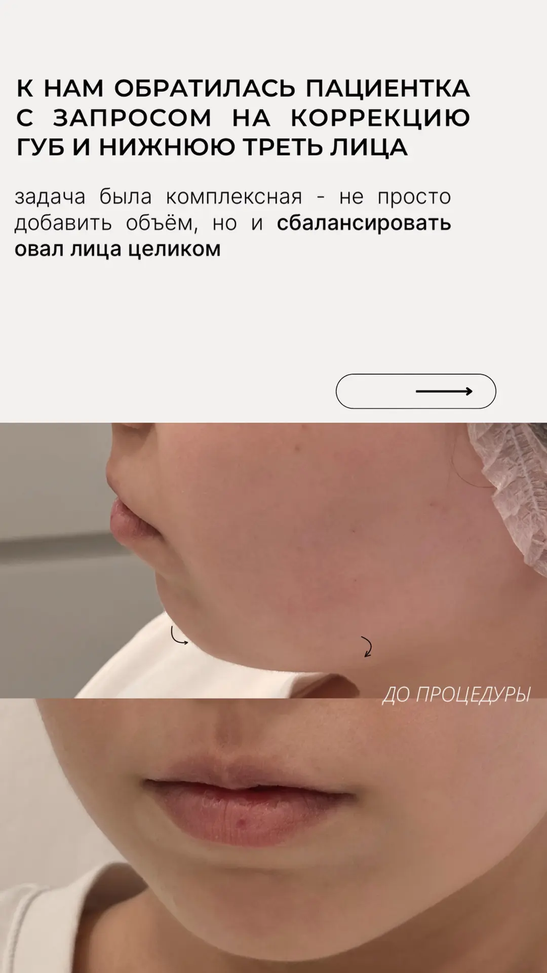 БЕЗУПРЕЧНЫЕ ЧЕРТЫ ЛИЦА ЗА 1 ВИЗИТ🤍

Провели коррекцию губ и моделирование подбородка - две зоны в о