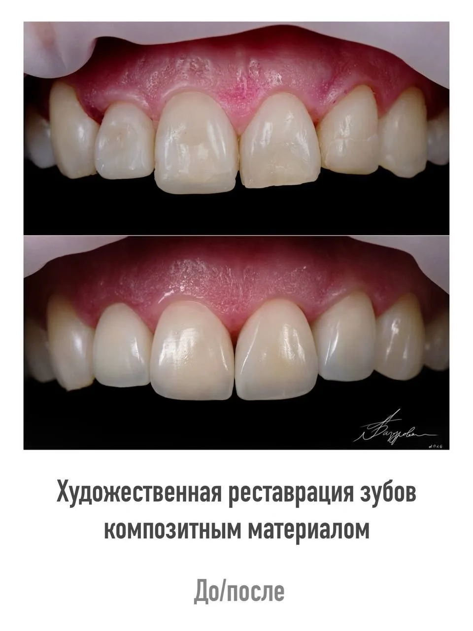 ✨Художественная реставрация зубов композитным материалом

Автор: Анна Базурова

CreativeDentistry