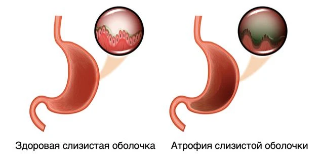 Атрофический гастрит

Атрофический гастрит – это хроническое воспаление слизистой оболочки желудка, 