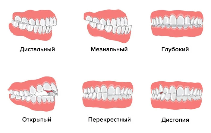 В предыдущем посте не верная первая картинка прикуса, вот верная. В этом максе не отредактировать ни