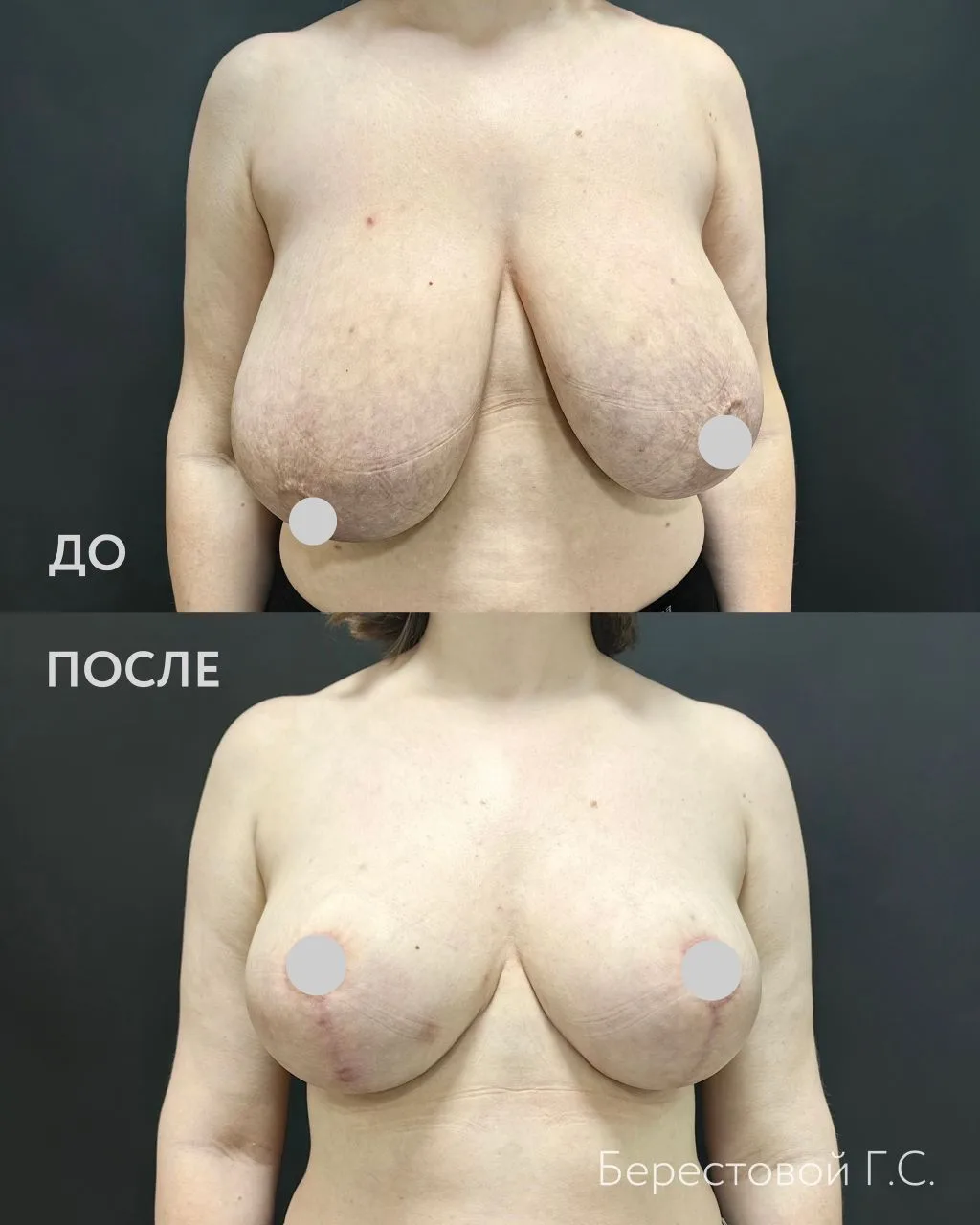 Якорная подтяжка груди без имплантов

Операция выполняется при выраженном опущении груди. Если собст