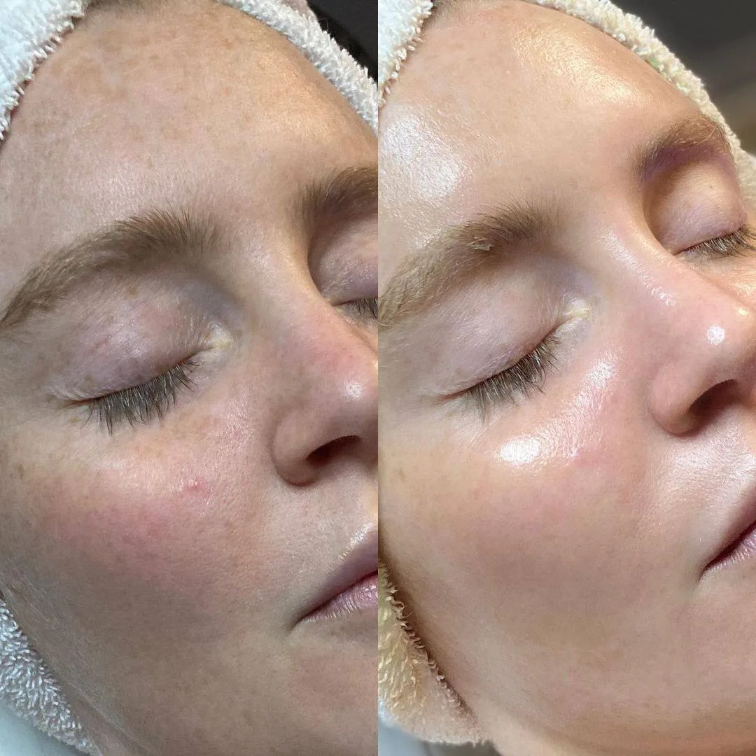 Тотальное увлажнение и сияние😍

Любимый протокол наших пациентов, который эффективно работает сразу
